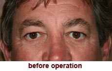 plastic-surgery-blepharoplasty